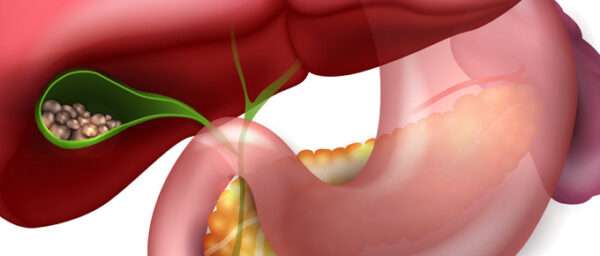 Colelitiasis