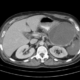 Complicaciones de la pancreatitis aguda