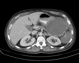 Complicaciones de la pancreatitis aguda