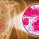 Biomarcadores Tumorales y Perfilado de Expresión Génica para cáncer de mama