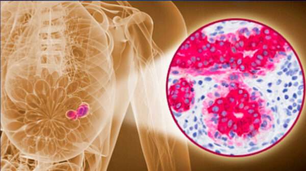 Biomarcadores Tumorales y Perfilado de Expresión Génica para cáncer de mama