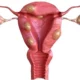 Leiomiomas uterinos (tumor fibroide)