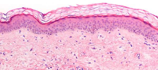 Formas clínicas especiales de cáncer de mama