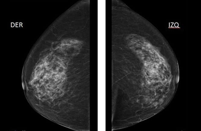 Cáncer de mama bilateral