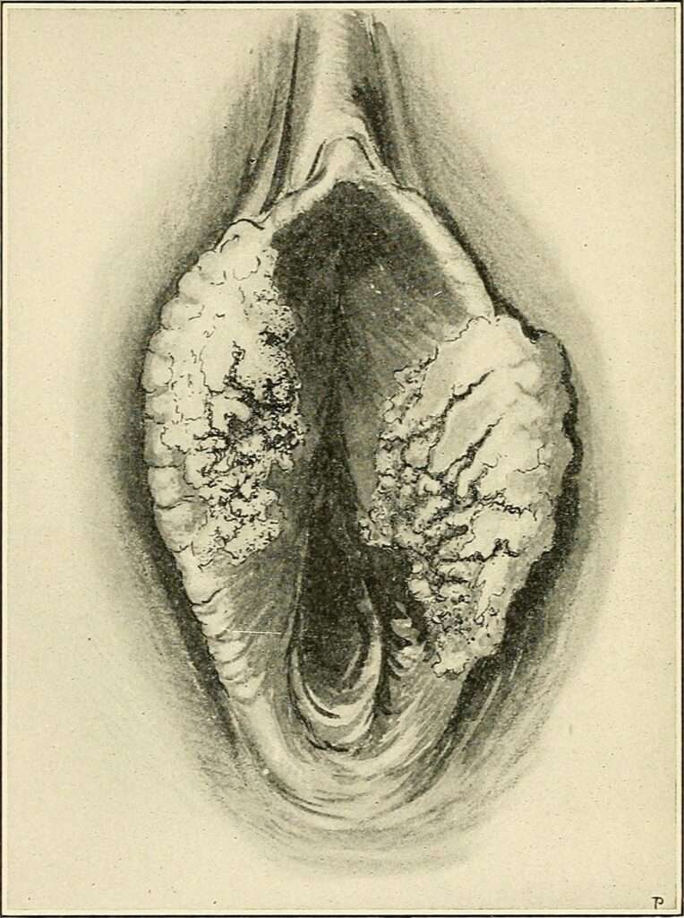 Carcinoma de vulva