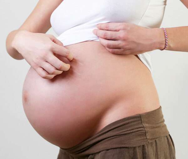 Varicela durante el embarazo