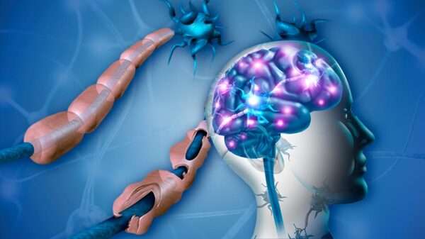 Esclerosis múltiple