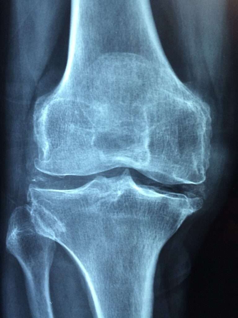 Osteoartritis