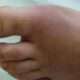 Artritis gotosa