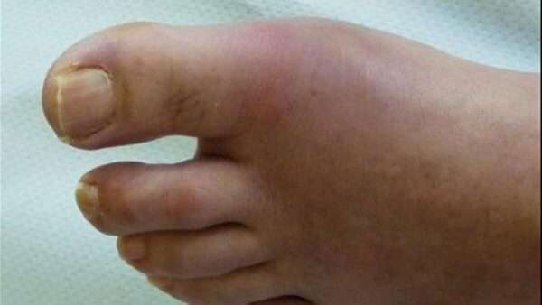 Artritis gotosa