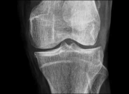 Deposición de Pirofosfato de calcio.