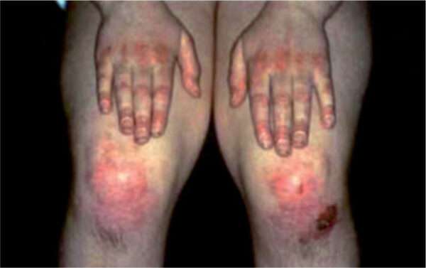 Miopatías inflamatorias inmunomediadas