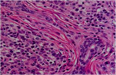 Enfermedad relacionada con inmunoglobulina IG4