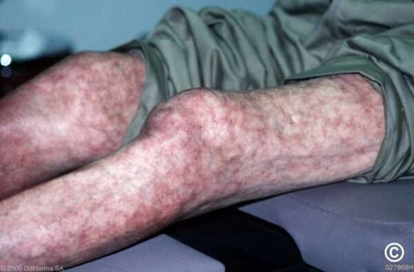 ¿Qué son livedo reticularis y livedo racemosa?