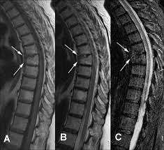 ¿Cuáles son las espondiloartropatías seronegativas?