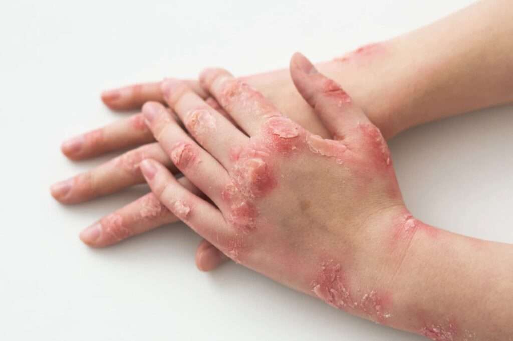 Artritis psoriásica