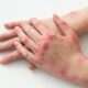 Artritis psoriásica