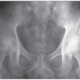 ¿Qué es la osteonecrosis?