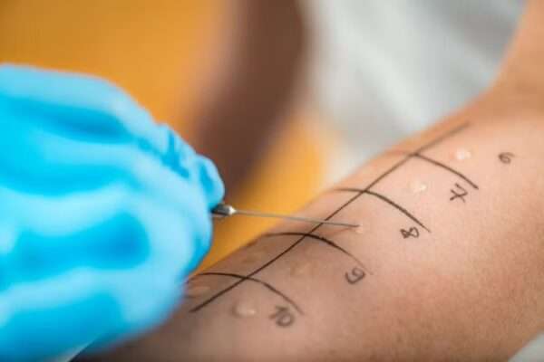 ¿Qué son las pruebas de alergia?