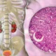 Nefritis intersticial