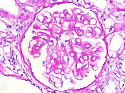 Clasificación de las enfermedades glomerulares