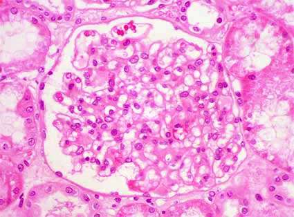 Enfermedad de cambios mínimos