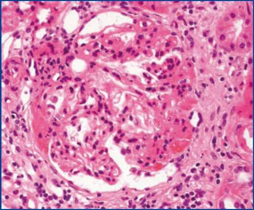 Glomeruloesclerosis segmentaria focal