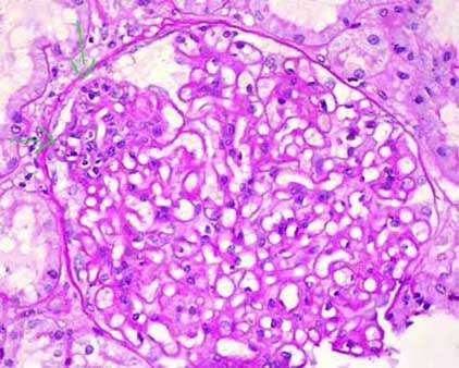 Nefropatía membranosa