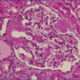 ¿Qué es la amiloidosis renal?