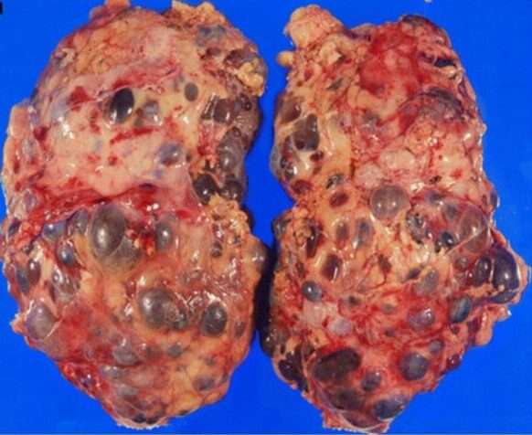 Enfermedad renal poliquística autosómica dominante