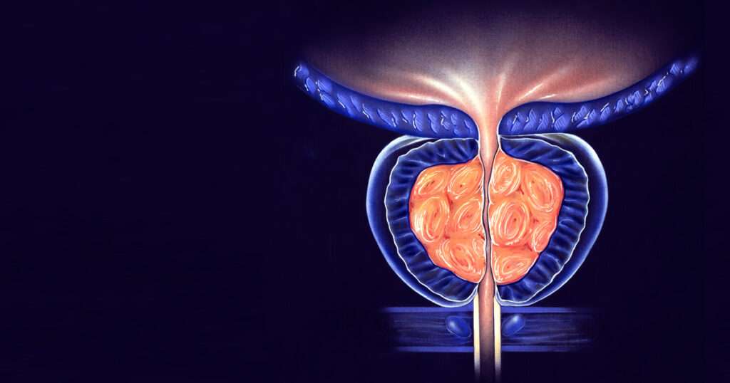Prostatitis bacteriana aguda