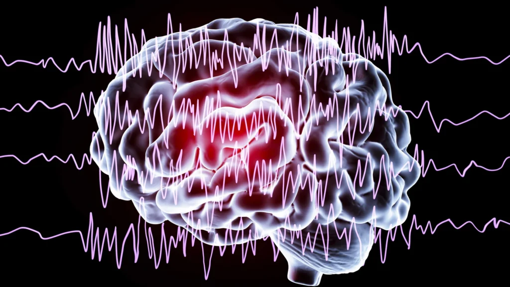 Tipos de convulsiones epilépticas