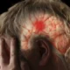 Infarto cerebral