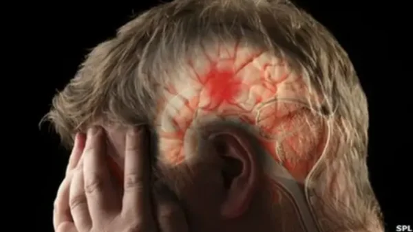 Infarto cerebral