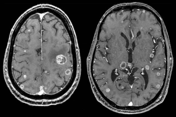 Tumores metastásicos intracraneales