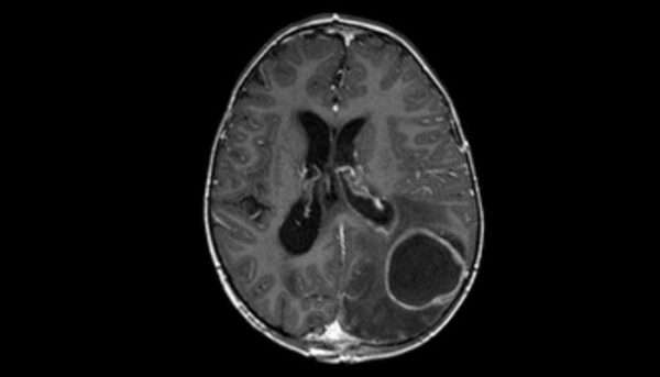 Absceso cerebral