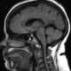Hipertensión intracraneal idiopática