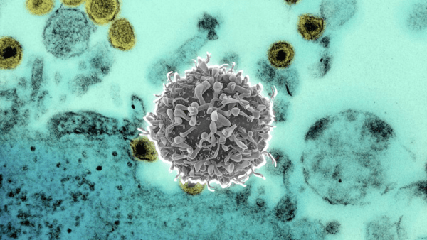 ¿Qué es la mielopatía por infección del virus de la leucemia de células T humanas?