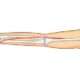 Lesiones del nervio radial