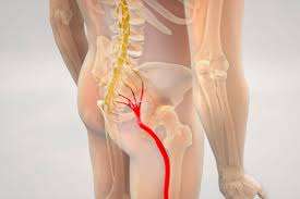 ¿Que es la parálisis del nervio ciático y fibular (peroneal común)?