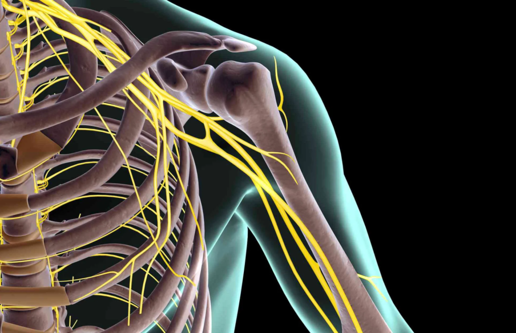 Neuropatía del plexo braquial
