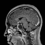 Adenomas hipofisarios no funcionales
