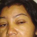 Hipotiroidismo y mixedema