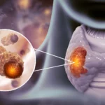 Cáncer de tiroides