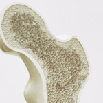 Osteopenia