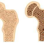 Osteoporosis