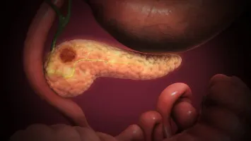 Hipoglucemia por tumor de células no insulares