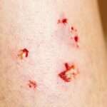 Heridas por mordedura de animales y humanos