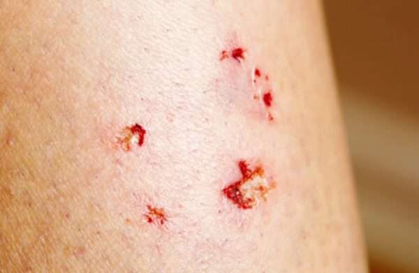 Heridas por mordedura de animales y humanos