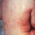 Enfermedad de Kawasaki